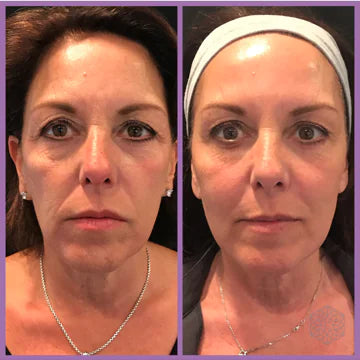 PRO Microcurrent Facial Toning Massager