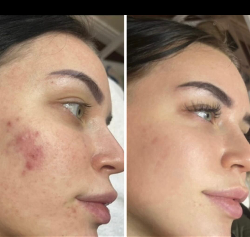 Professional Grade LED Skin Rejuvenation Mask