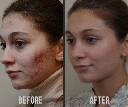 Professional Grade LED Skin Rejuvenation Mask