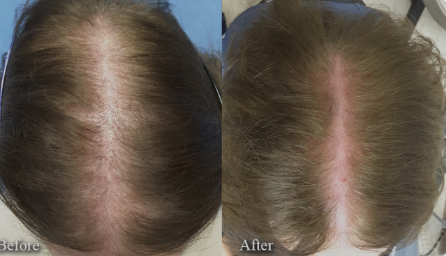 Advanced Infrared Red Light Hair Growth Cap