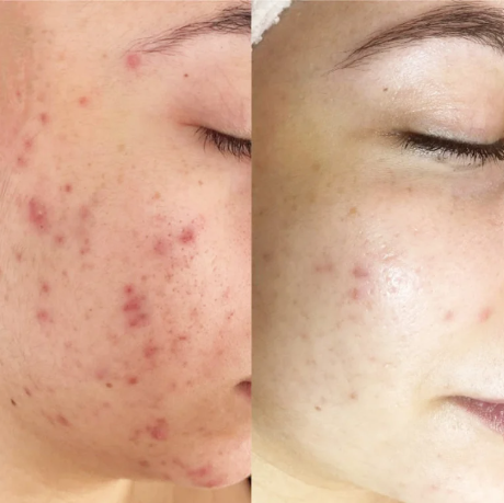 Professional Grade LED Skin Rejuvenation Mask