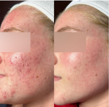 Professional Grade LED Skin Rejuvenation Mask