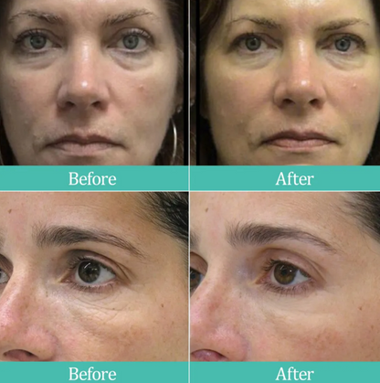 Professional Grade LED Skin Rejuvenation Mask